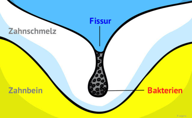 Zahnfissur mit Bakterien