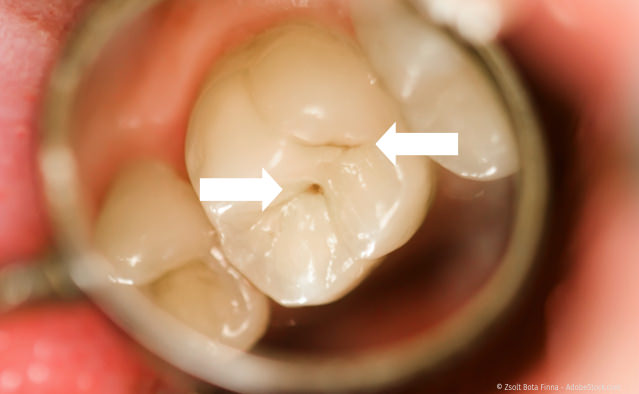 Fissurenkaries an einem Backenzahn