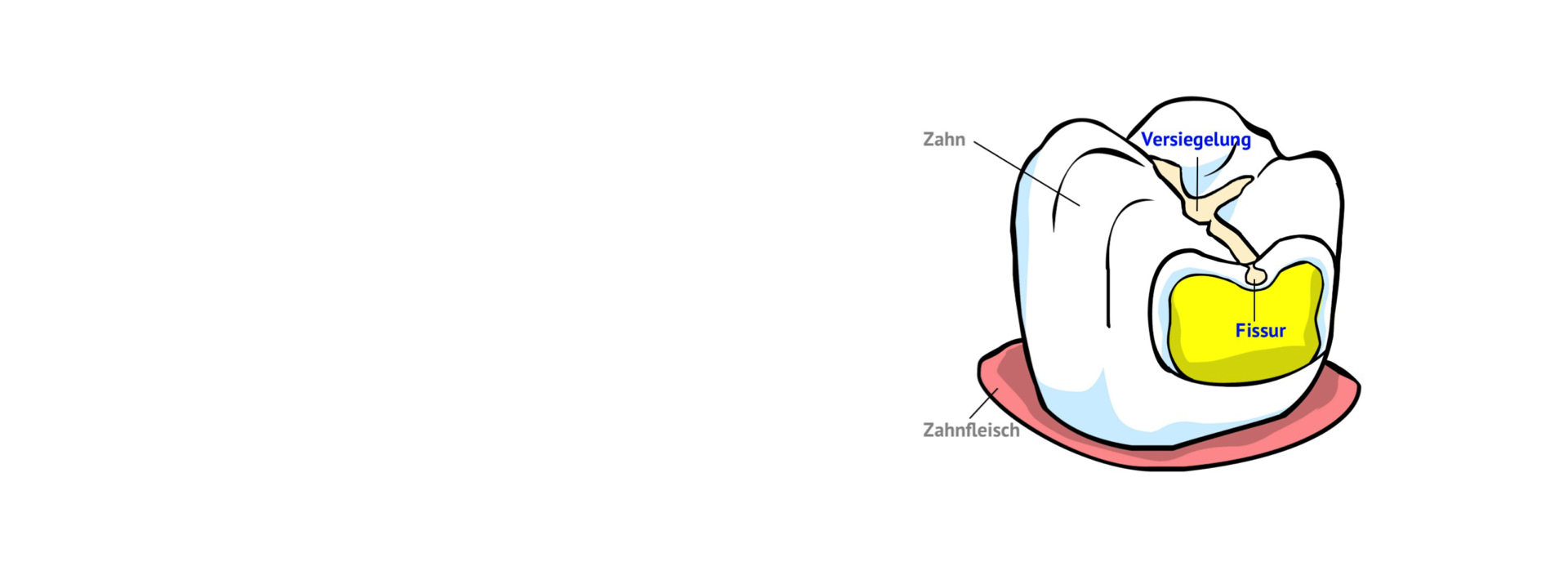 Fissurenversiegelung der Backenzähne zum Schutz vor Karies
